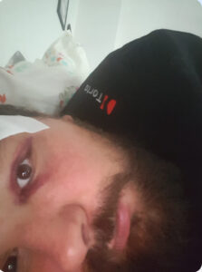 Dystrofia mięśniowa, wózek i kask - obowiązek czy przesada? twarz po wypadku Marcin